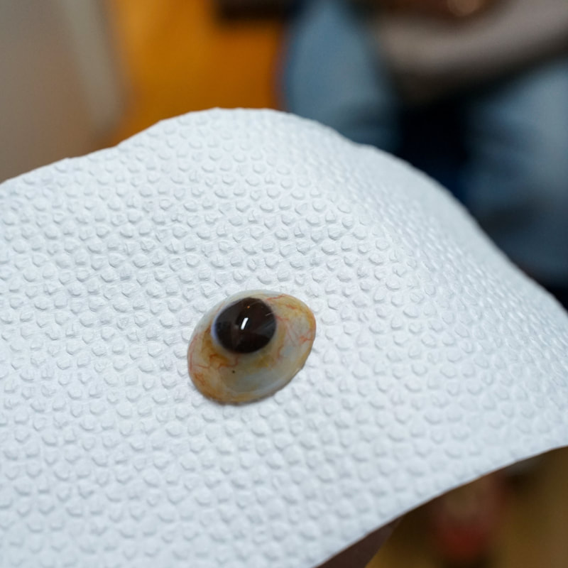 Enucleation and Evisceration: What to Expect